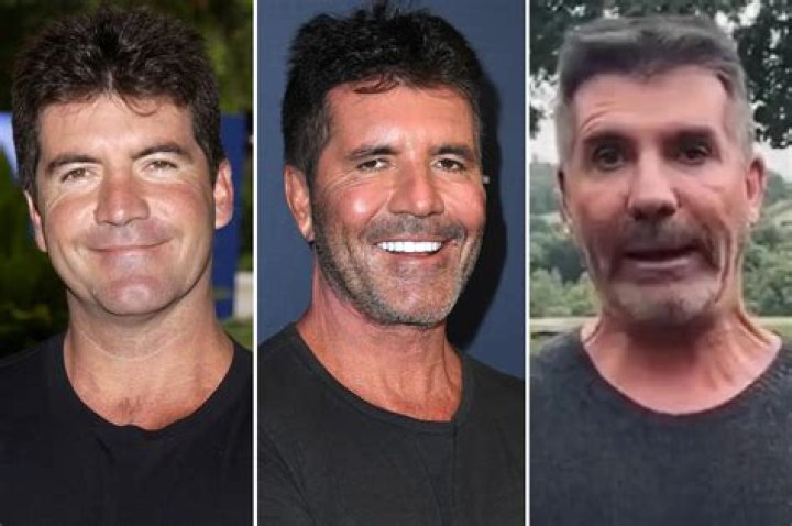 What Happened To Simon Cowell Face And Eye? Has He Had A Stroke Or An Accident?
